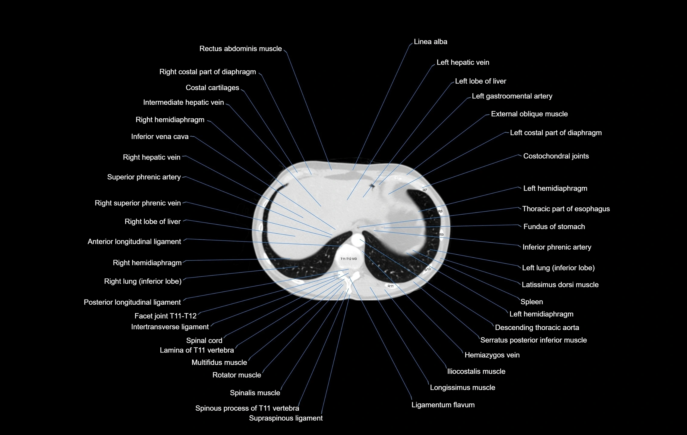 CT chest (thorax) labelled axial cross sectional anatomy radiology image-00105.webp